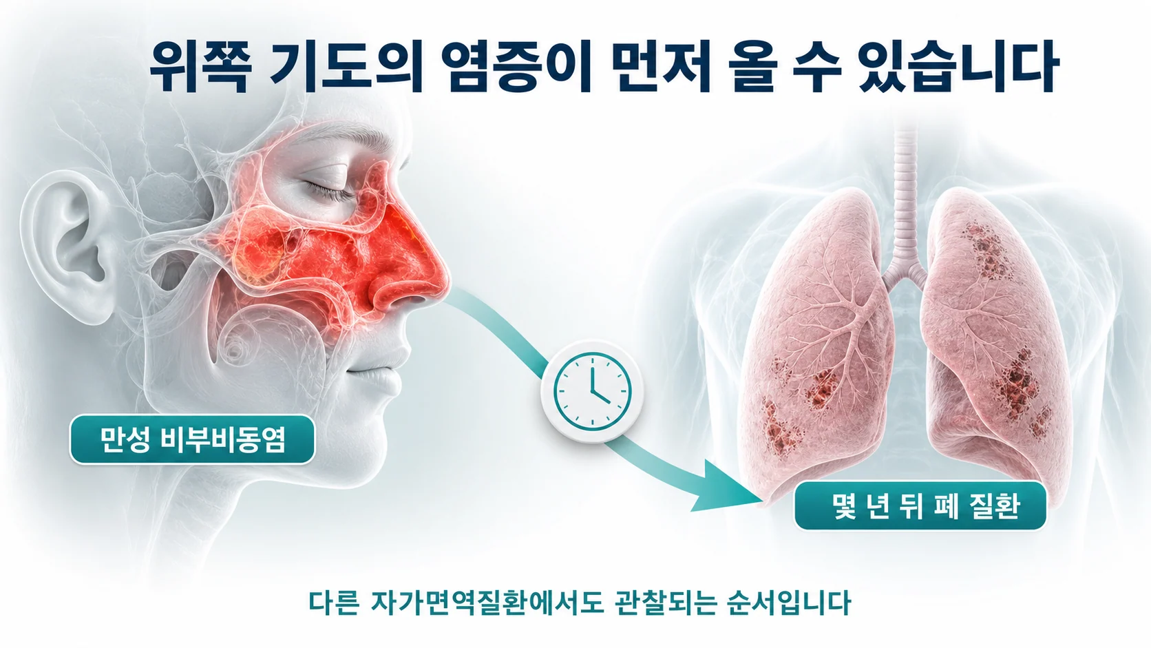 코와 부비동의 만성 염증이 몇 년 뒤 폐 질환 위험과 연결된다는 개념을 설명하는 이미지