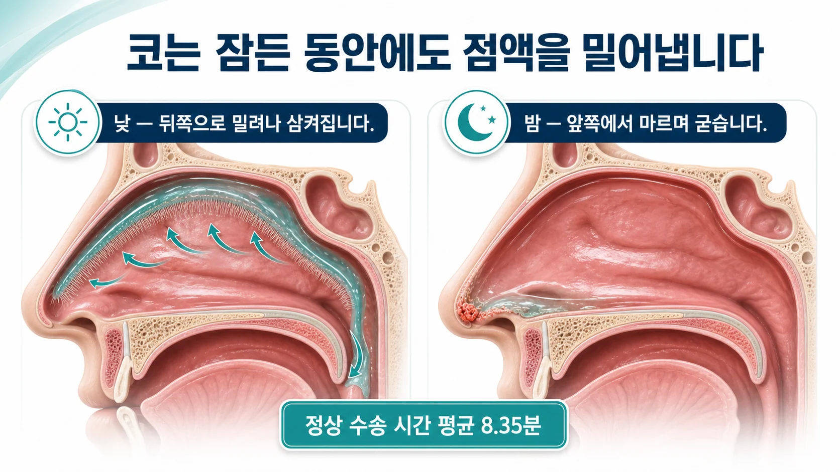 코 점막의 섬모가 점액을 뒤쪽으로 밀어내는 정상 수송 과정과 밤사이 앞쪽에서 굳어 코딱지가 되는 과정을 나란히 보여주는 단면 그림