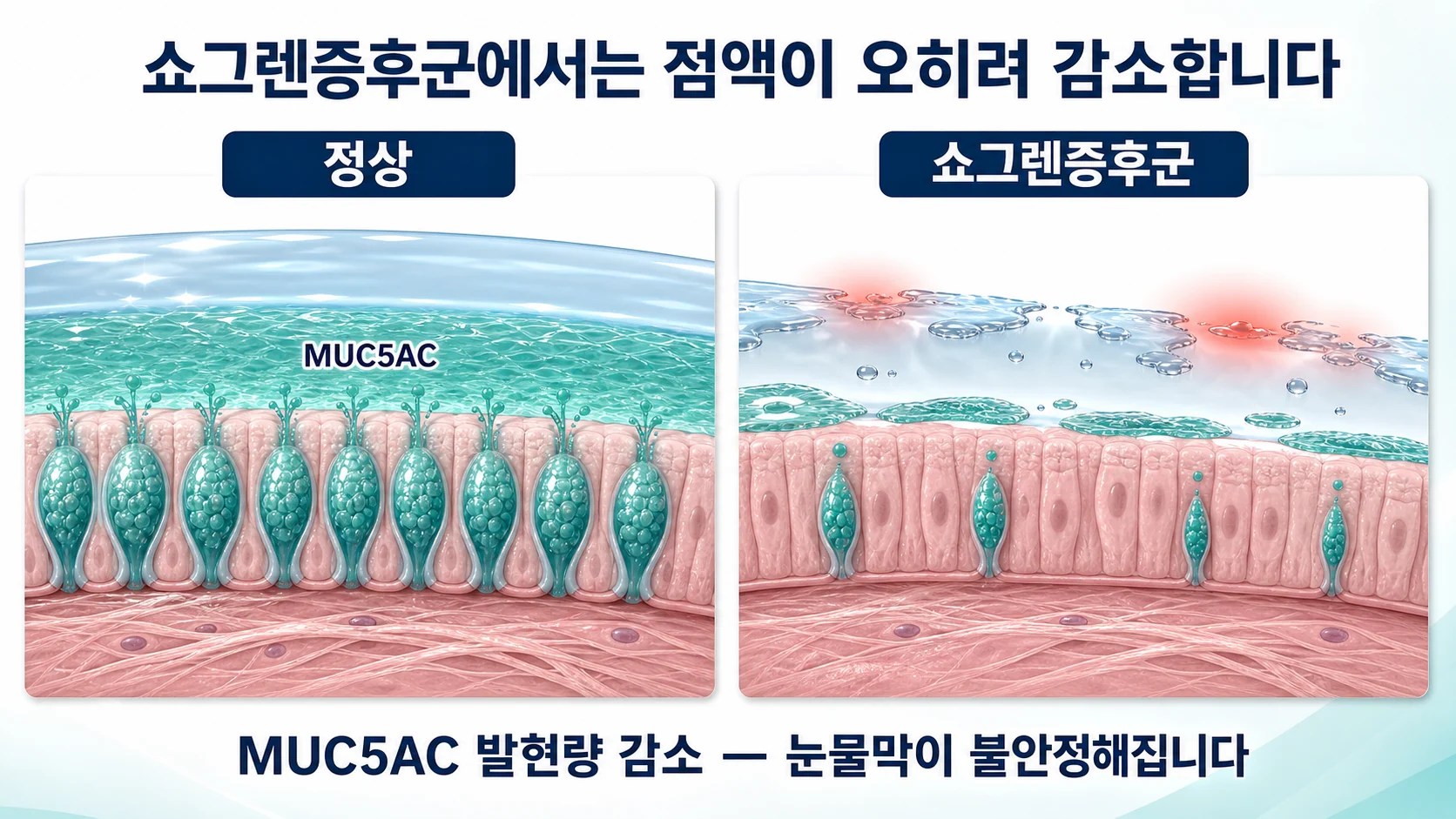 쇼그렌증후군에서 결막 술잔세포의 MUC5AC 발현량이 감소해 눈물막이 불안정해지는 과정을 정상 상태와 비교해 보여주는 그림