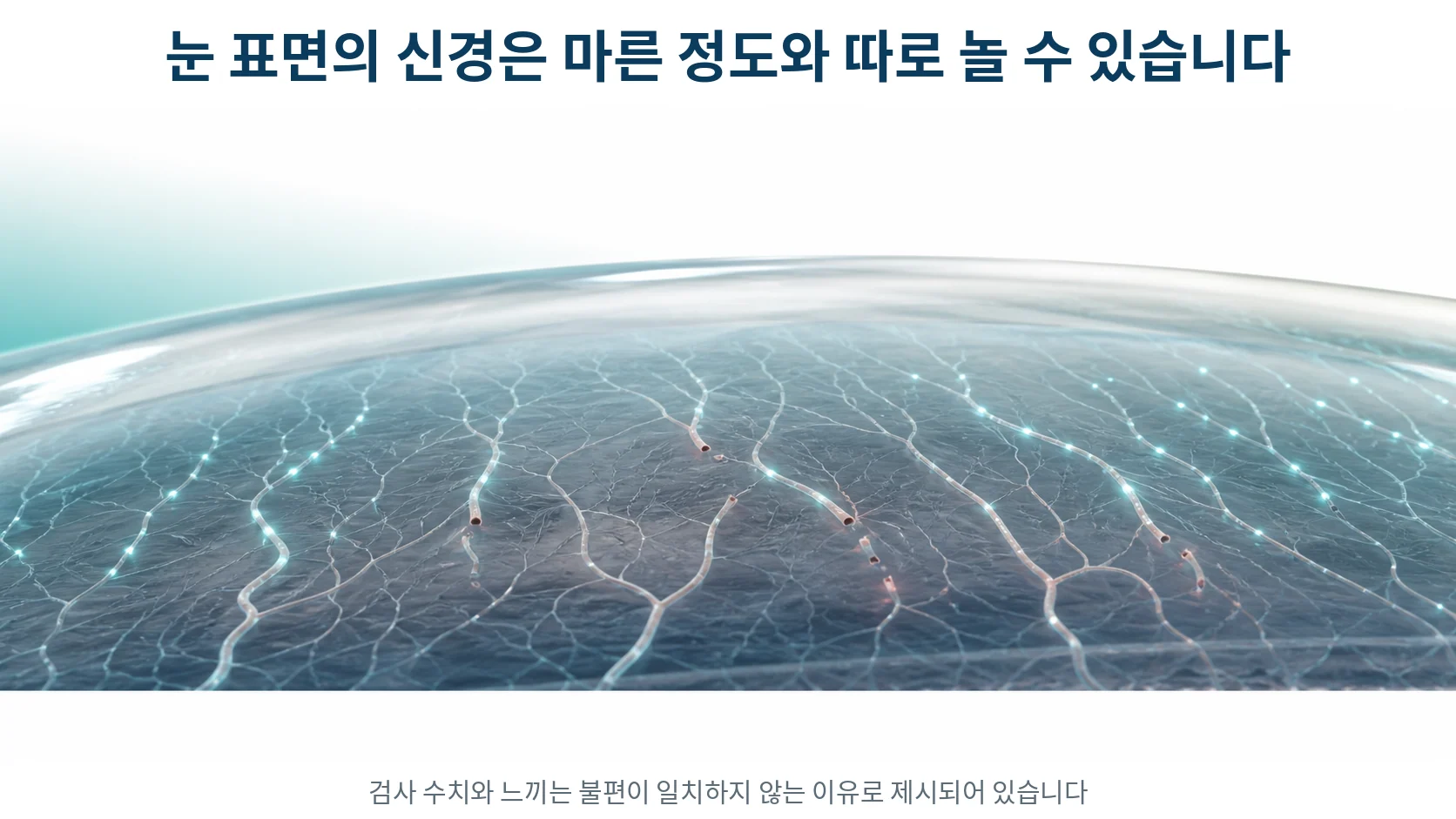 각막 표면에 퍼진 가느다란 신경 가지가 손상되어 신호가 고르지 않게 전달되는 모습을 그린 확대 그림