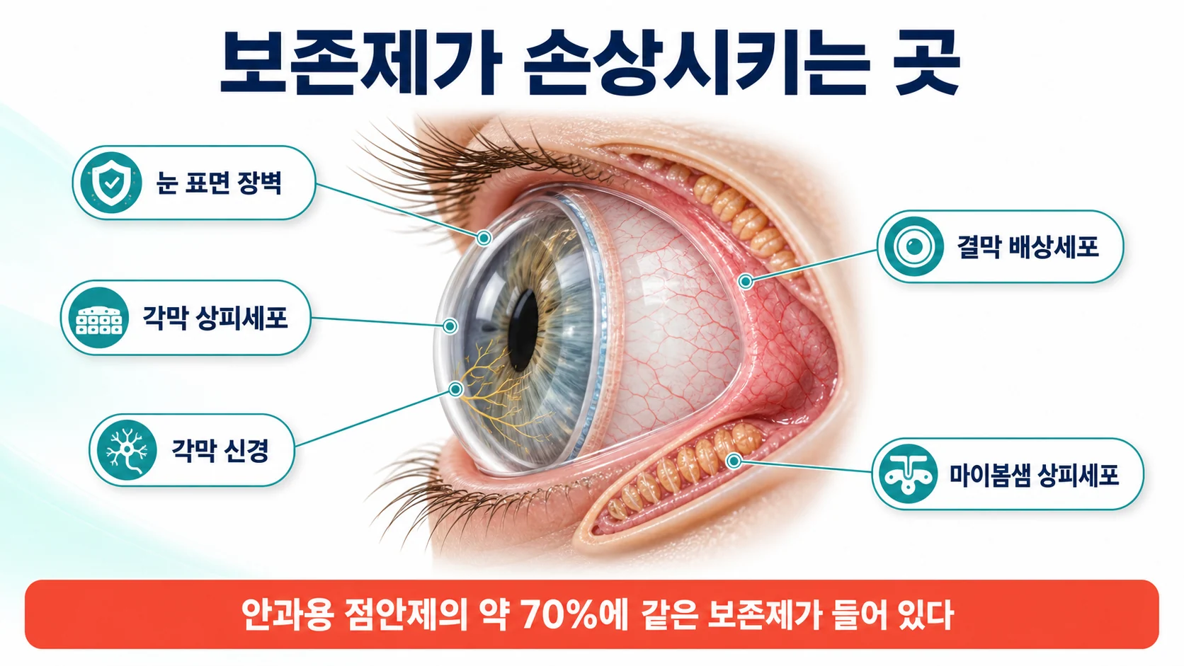 보존제가 눈 표면에서 손상시키는 구조물들