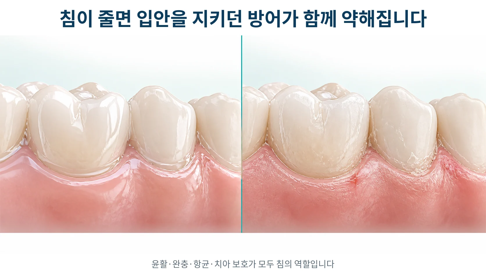 침이 충분한 입안과 침이 줄어든 입안에서 치아 표면과 점막의 상태를 비교해 그린 그림