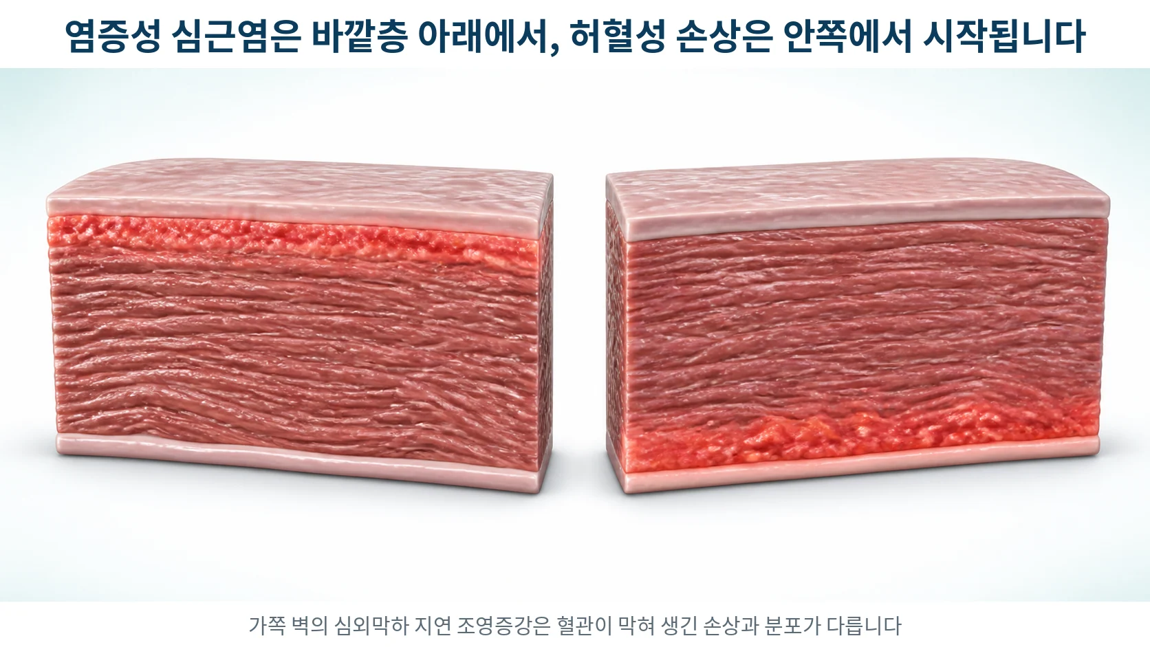 심장 근육 벽을 잘라 세 층으로 보여 주고 바깥층 바로 아래에 붉은 띠가 놓인 단면 그림과 안쪽에 붉은 띠가 놓인 비교 그림