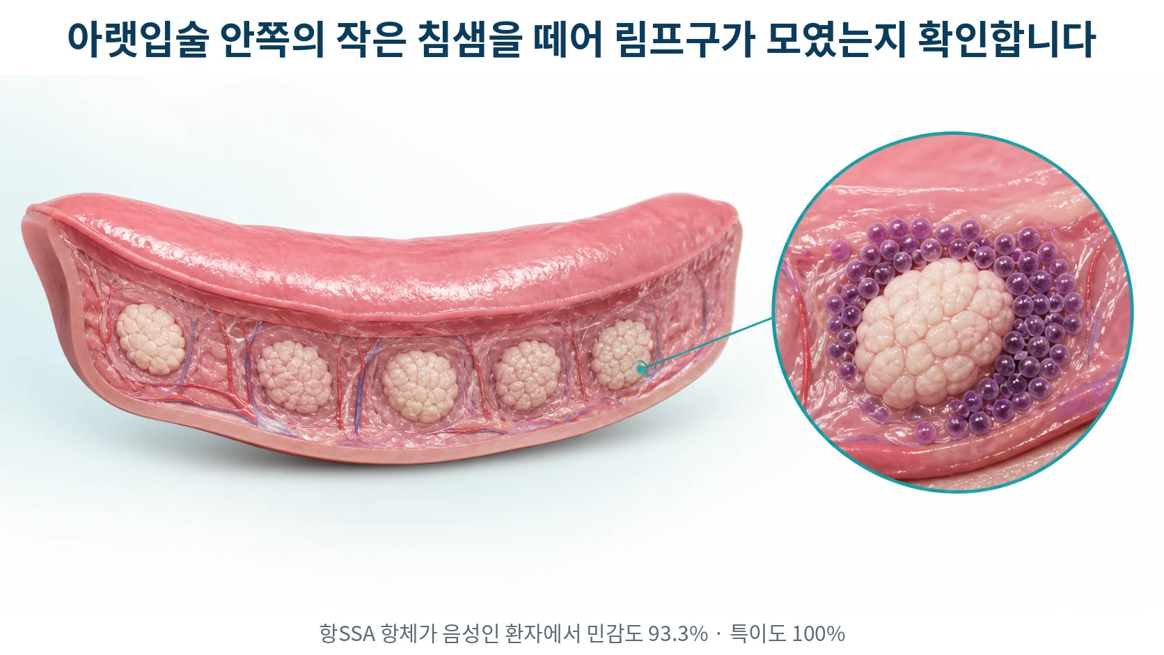 아랫입술 안쪽 점막 아래에 놓인 작은 침샘들의 단면과 림프구가 침샘 소엽 둘레에 빽빽하게 모인 확대 그림