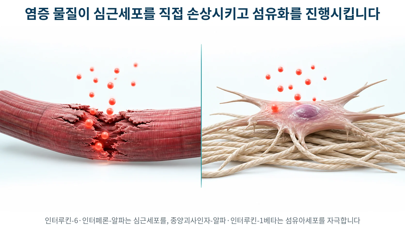 왼쪽에서는 염증 물질이 심근세포를 손상시키고 오른쪽에서는 섬유아세포가 활성화되어 아교질 섬유를 쌓는 두 갈래 경로 그림