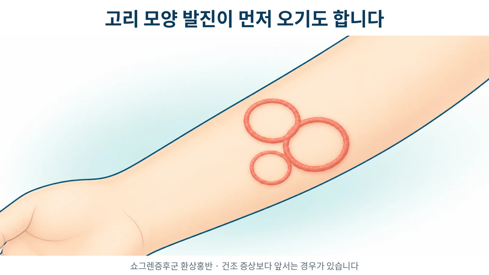 쇼그렌증후군에서 나타나는 환상홍반
