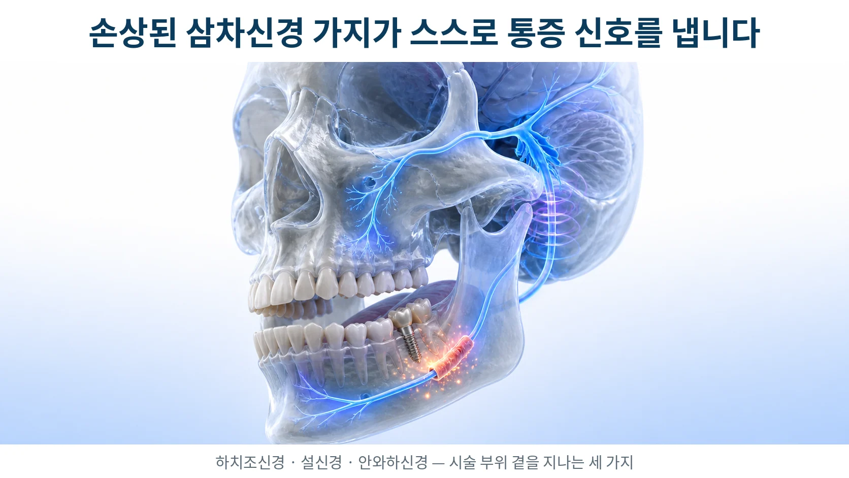 삼차신경 하치조신경·설신경·안와하신경 분지와 손상 부위에서 생기는 이소성 발화를 표현한 3D 의료 일러스트
