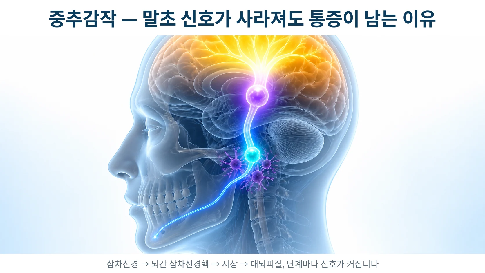 말초 신경 신호가 뇌간 삼차신경핵을 거쳐 대뇌피질에서 증폭되는 중추감작 경로를 표현한 3D 의료 일러스트