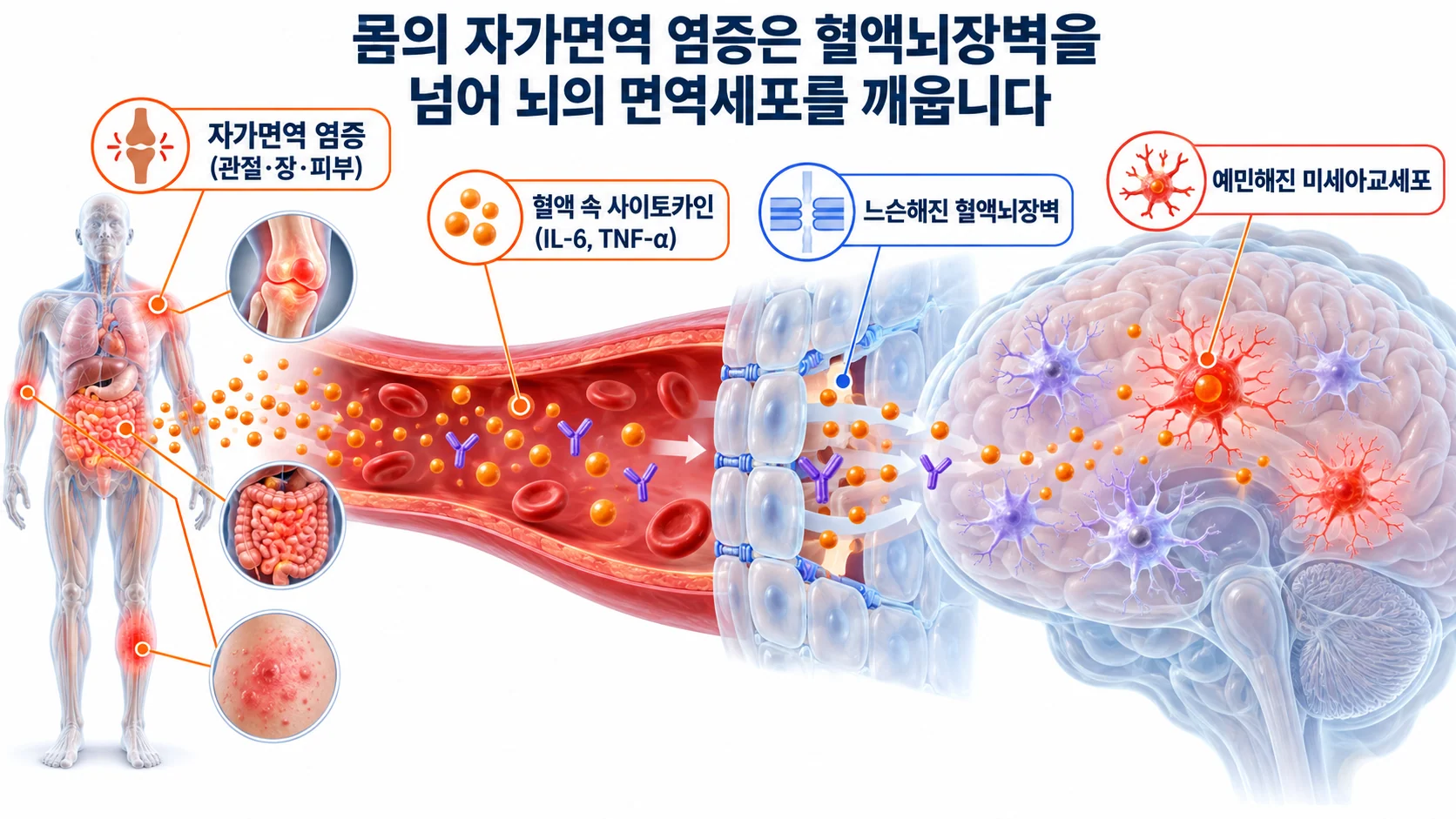 관절·장·피부의 자가면역 염증에서 나온 사이토카인이 느슨해진 혈액뇌장벽을 지나 뇌의 미세아교세포를 활성화하는 과정