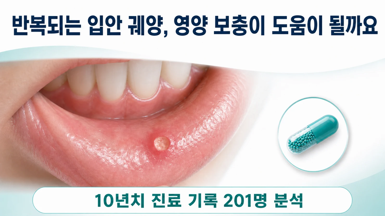 재발성 아프타성 구내염에 영양 보충이 도움이 되는지를 묻는 의료 인포그래픽