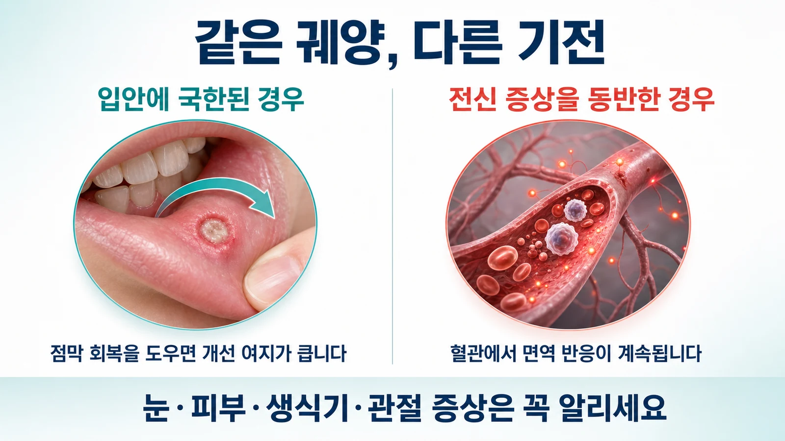 입안 궤양만 있는 경우와 전신 증상이 동반된 경우의 기전 차이를 대비한 의학 인포그래픽