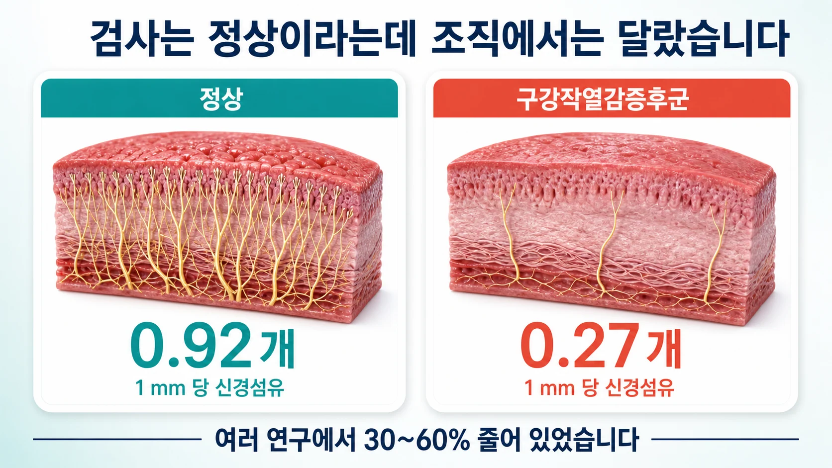 혀 조직에서 확인된 신경섬유 감소