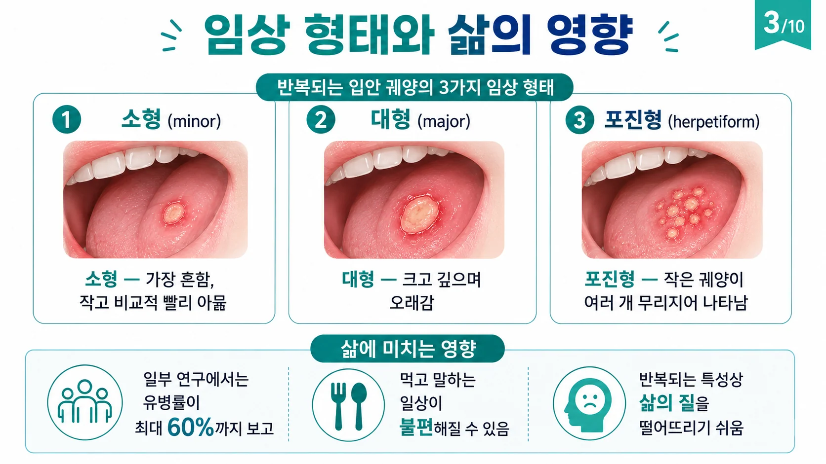 아프타성 궤양의 3가지 임상 형태 — 소형·대형·포진형