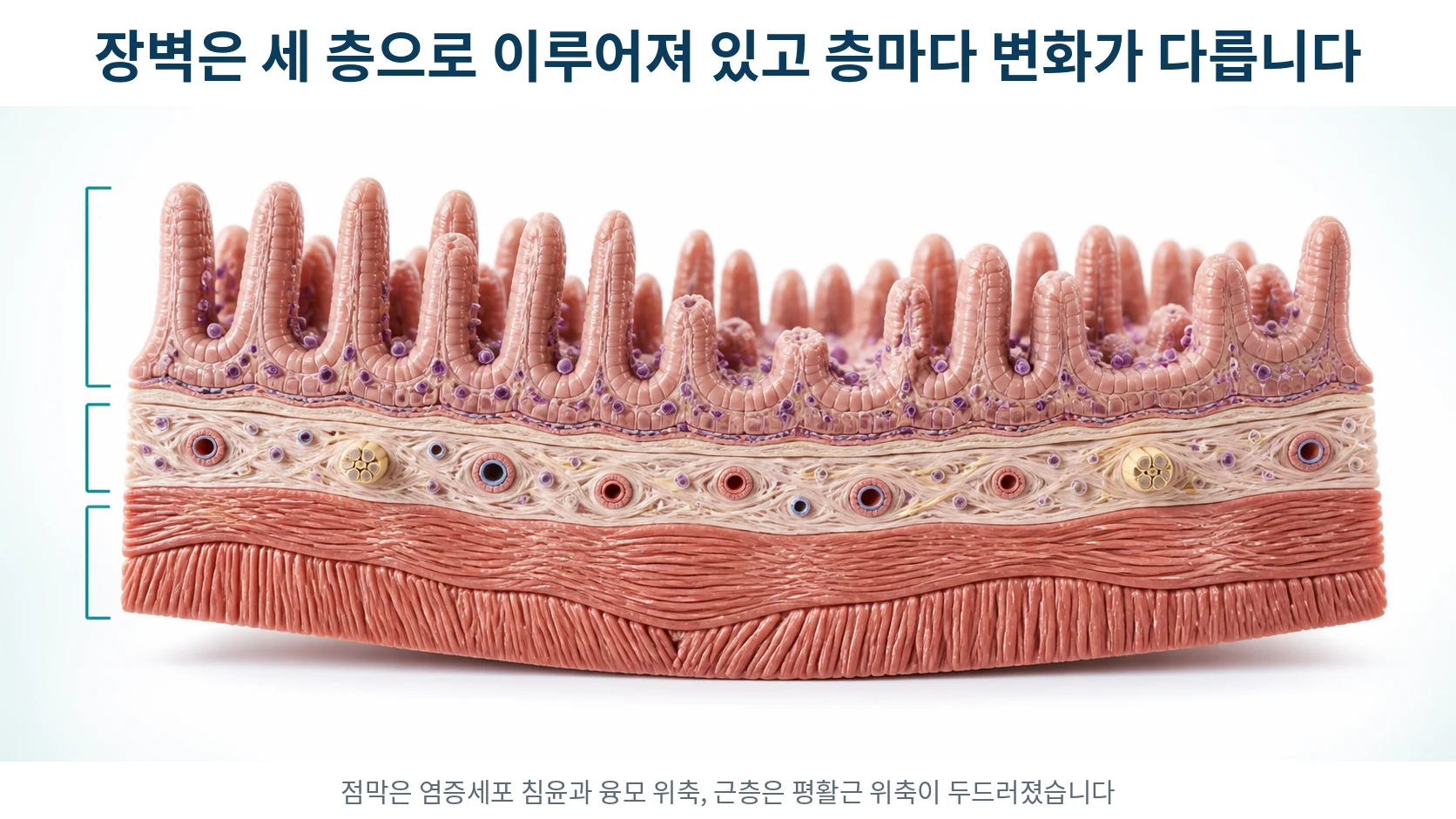 장벽을 잘라 점막층과 점막하층과 근층으로 나누어 보여 주고 각 층의 구조를 확대한 단면 그림