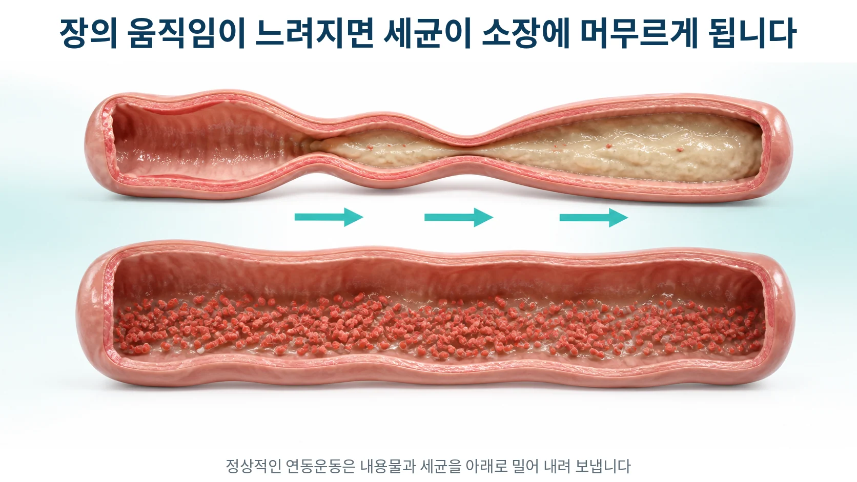 위쪽에는 정상적인 연동운동으로 내용물이 밀려 내려가는 소장을, 아래쪽에는 움직임이 줄어 세균이 고여 있는 소장을 그린 비교 그림