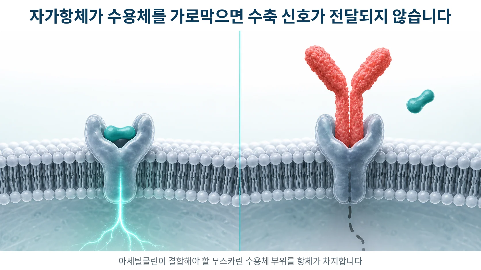 세포막의 수용체에 신경전달물질이 결합하는 정상 상태와 자가항체가 수용체를 막아 신호가 끊긴 상태를 나란히 그린 그림