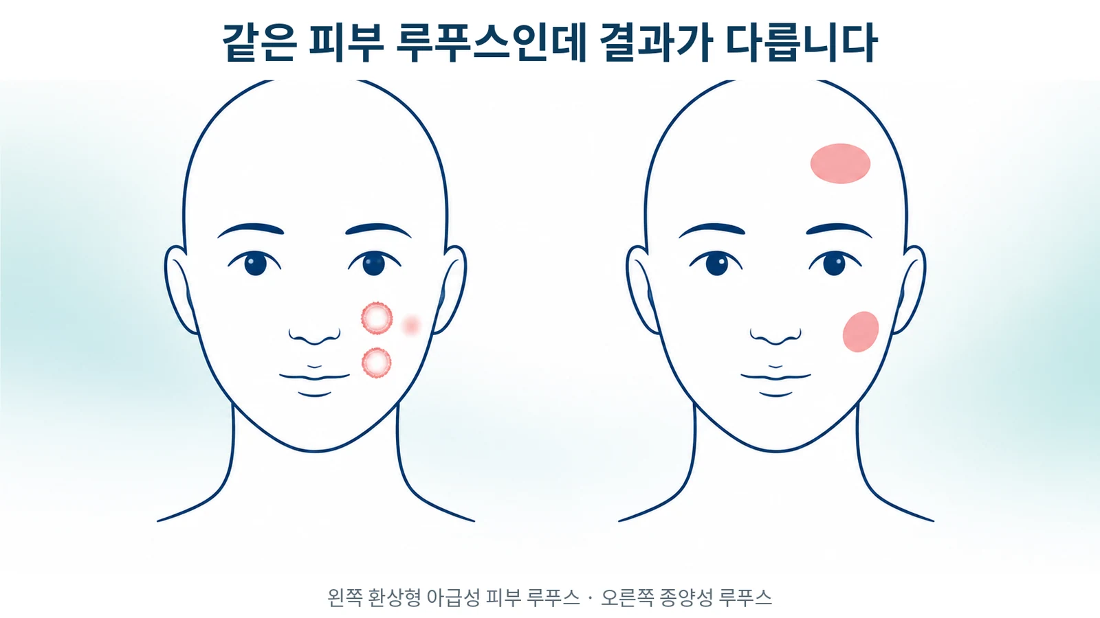 종양성 루푸스(lupus erythematosus tumidus, LET)와 환상형 SCLE