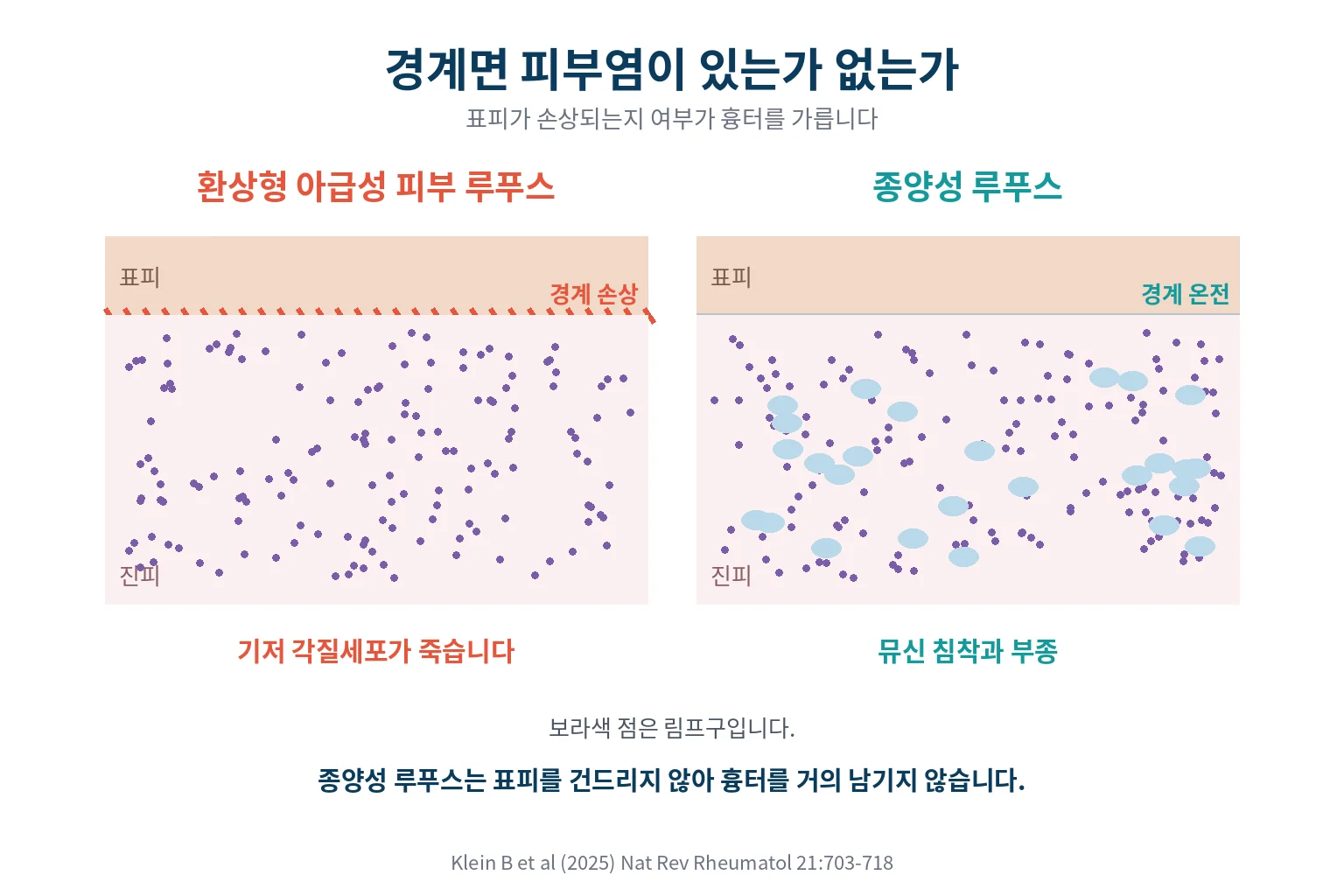 경계면 피부염이 있는가 없는가