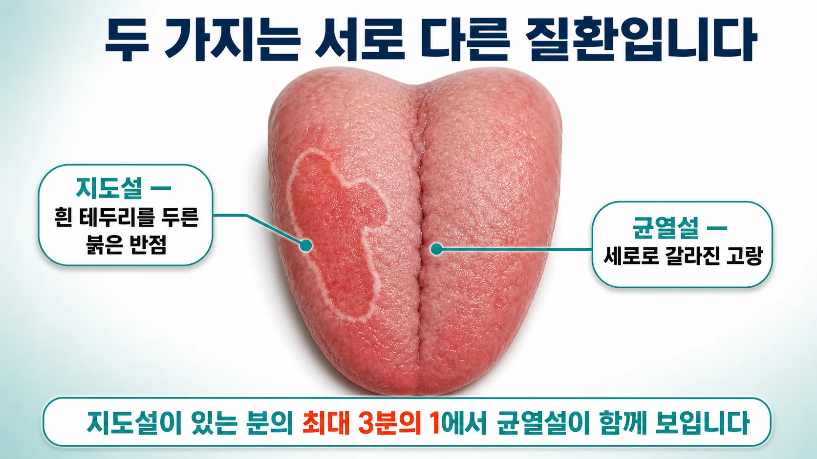 혀에 지도 모양 무늬와 갈라진 고랑이 함께 나타난 모습을 보여주고 두 가지가 서로 다른 질환임을 설명하는 그림