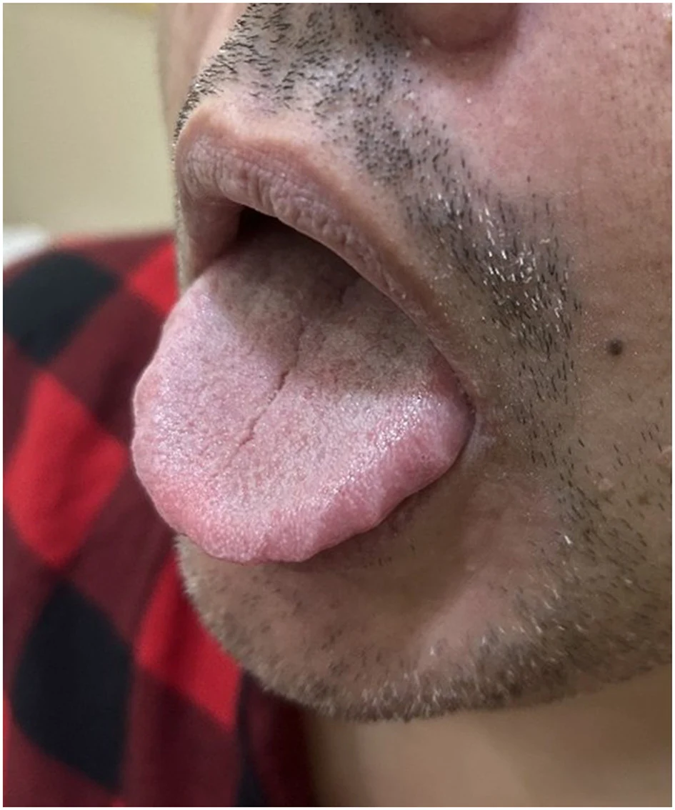치흔설 사진 — 혀를 내밀었을 때 양쪽 가장자리에 물결 모양의 자국이 보이는 실제 임상 사진
