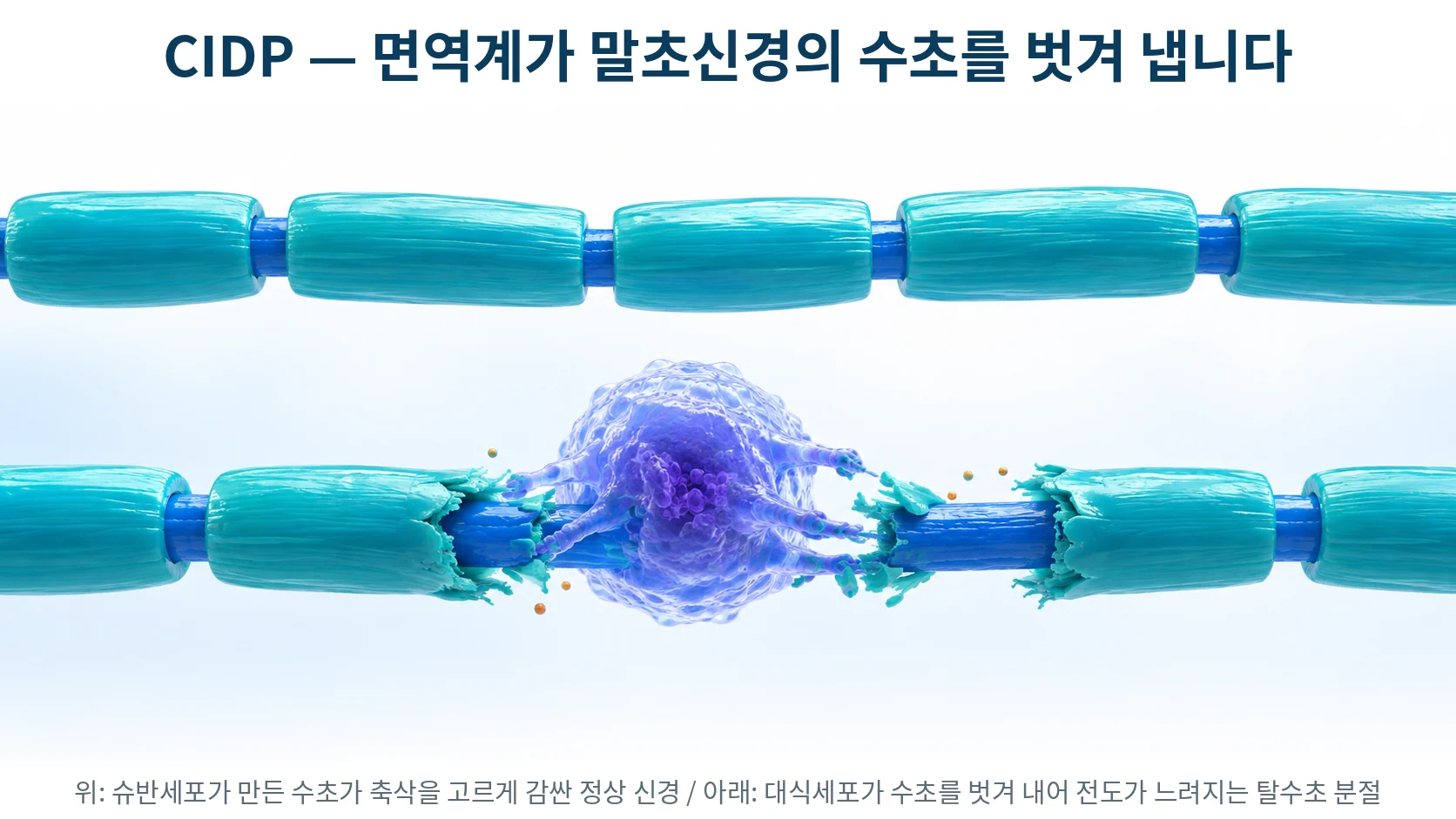 말초신경 축삭을 감싼 정상 수초와, 대식세포가 수초를 벗겨 내는 탈수초 분절을 나란히 보여주는 3D 의료 일러스트