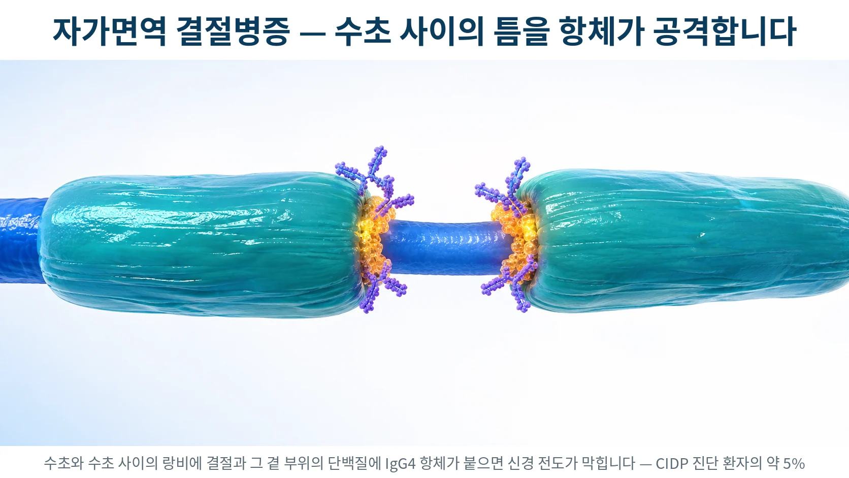 랑비에 결절과 곁결절 부위의 구조 — 뉴로파신-155·콘탁틴-1 같은 결절 단백질에 항체가 결합하는 자가면역 결절병증을 표현한 3D 의료 일러스트