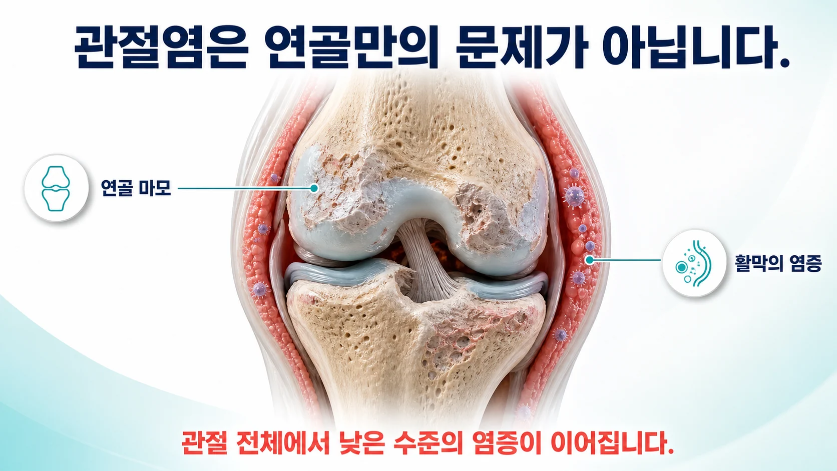 골관절염, 연골이 닳았다는 말만으로 설명이 안 될 때
