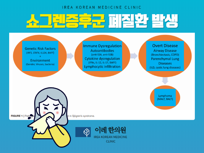 폐질환 발생 원인