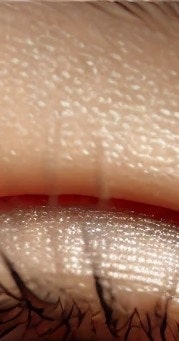 안구건조증 관리