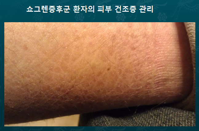 쇼그렌증후군 환자의 피부건조증 관리방법