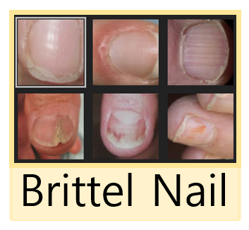쇼그렌증후군에 증상 중 손톱 갈라짐(Birttle Nails)