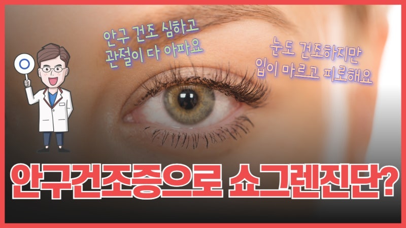 심한 안구건조증, 쇼그렌증후군을 의심해야 하는 순간은 언제인가요?