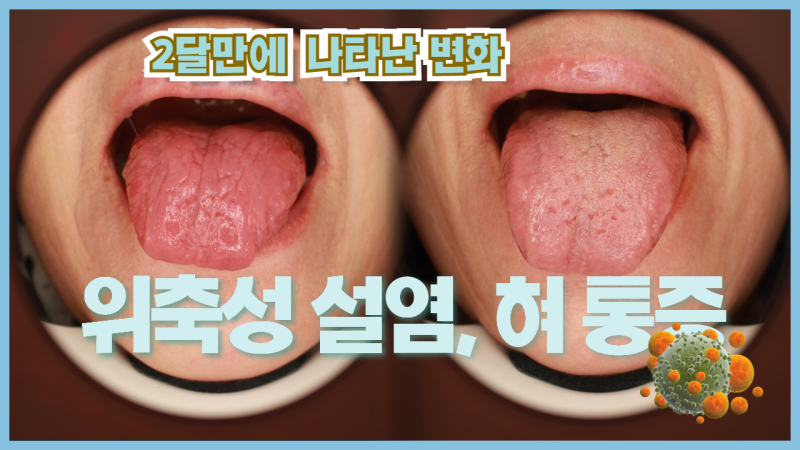 위축성 설염과 쇼그렌증후군: 혀 통증과 입맛 변화의 원인