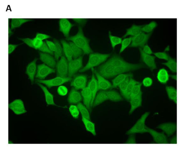 Anti-Jo1 양성과 간질성 폐질환
