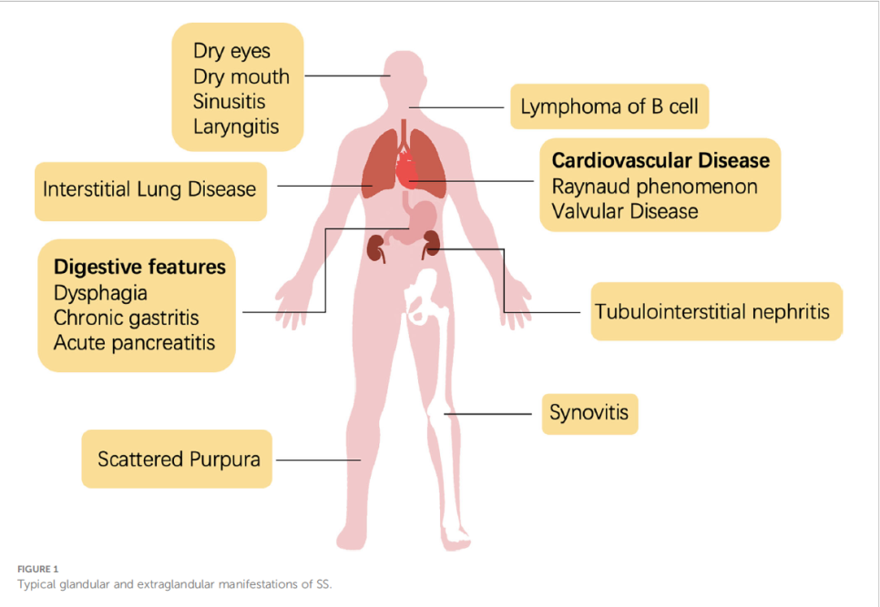 심낭염 발생 메커니즘 도식