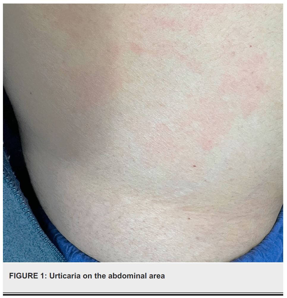 자가면역 기반 두드러기 설명