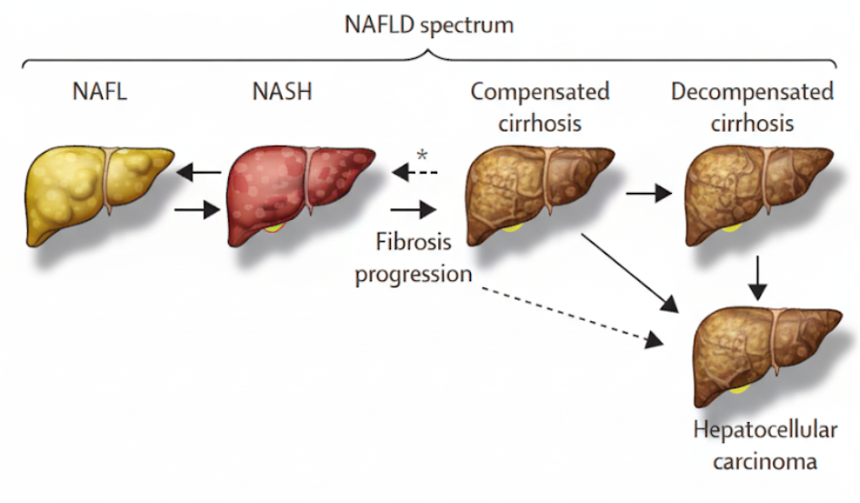 비알코올성 지방간질환 설명