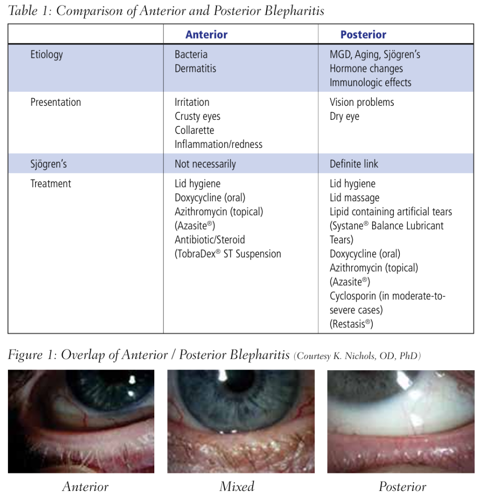 쇼그렌증후군과 후방 안검염: 다래끼 없이 생기는 안검염의 원인과 치료