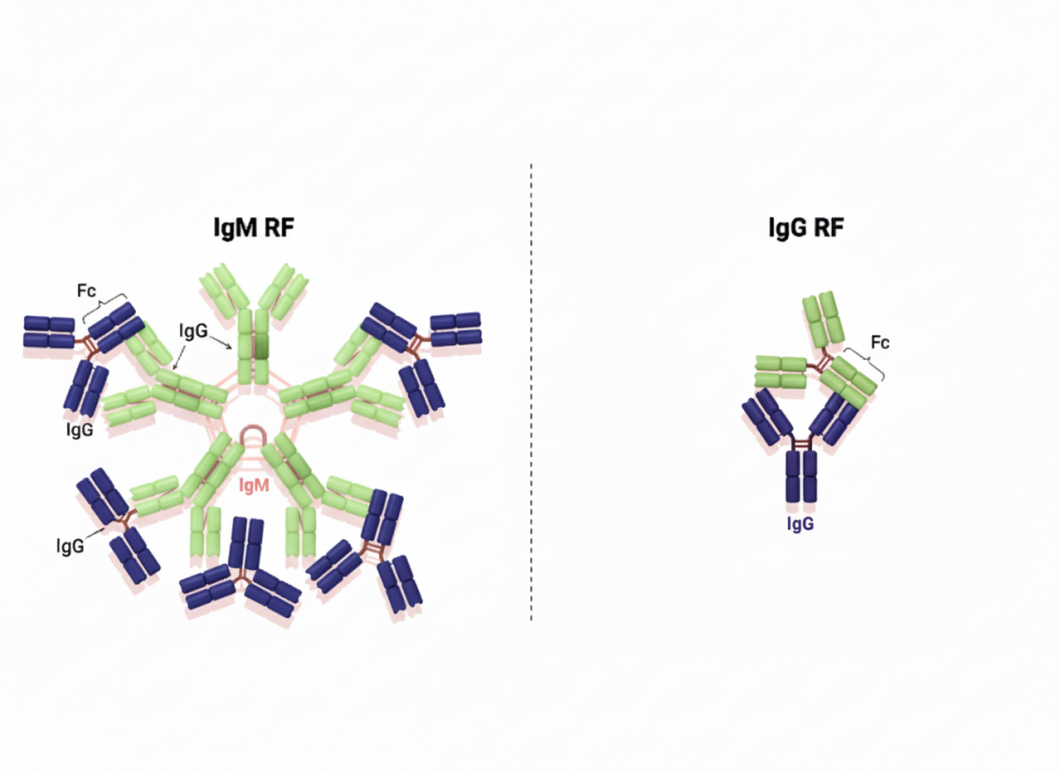 쇼그렌증후군 진단 검사: 류마티스 인자(RF) 양성의 의미와 해석