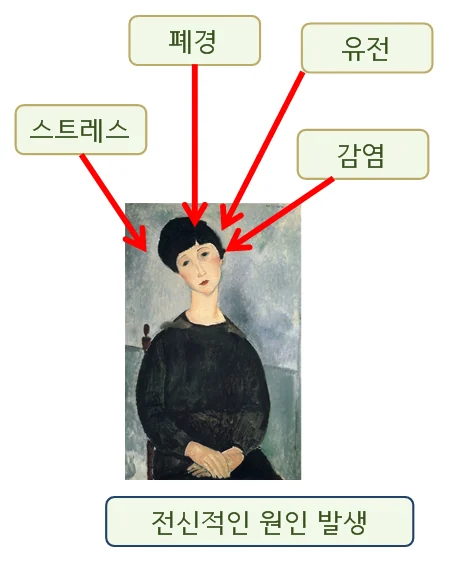쇼그렌 증후군 자가항체가 증폭되는 기전, 인천 이레 한의원