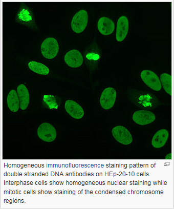 쇼그렌증후군 루푸스 등에 나타나는 항핵항체