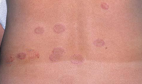 쇼그렌증후군 에서 나타나는 윤상홍반