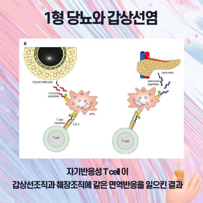 그레이브스병과 1형 당뇨의 병리적 상관관계