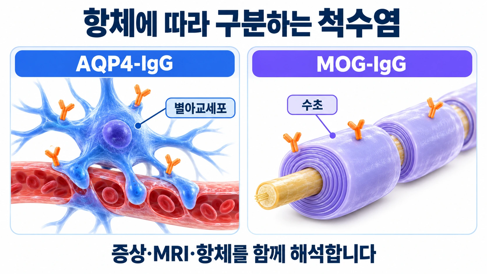 AQP4 항체의 별아교세포 표적과 MOG 항체의 수초 표적을 나란히 설명한 의학 모식도
