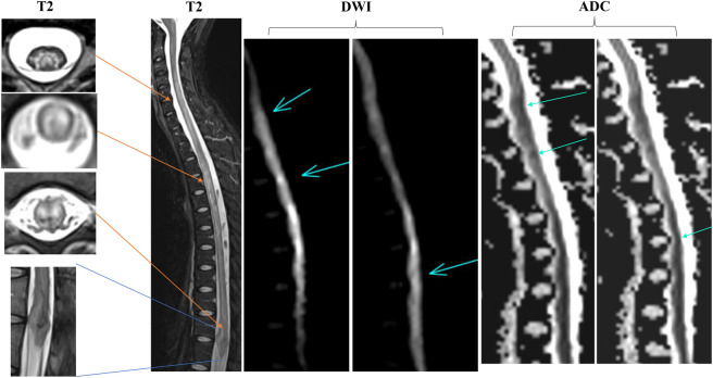 루푸스 환자에서 염증성 소견과 혈류 장애가 의심되는 소견이 함께 관찰된 원문 MRI