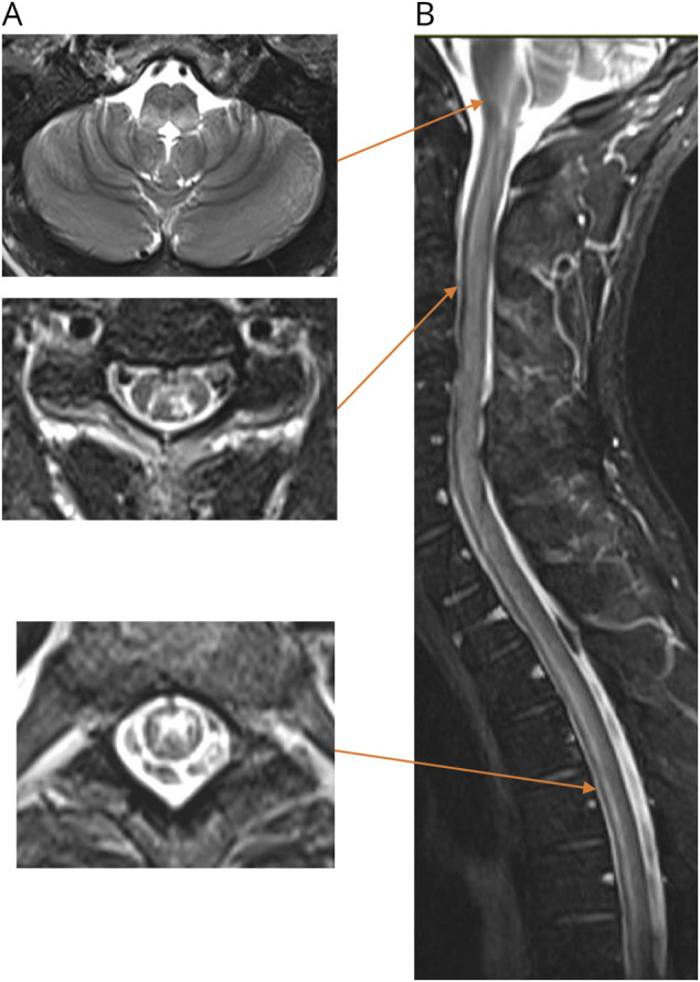 루푸스와 항체 음성 NMOSD가 동반된 증례에서 뇌간과 척수 병변을 보여주는 원문 MRI