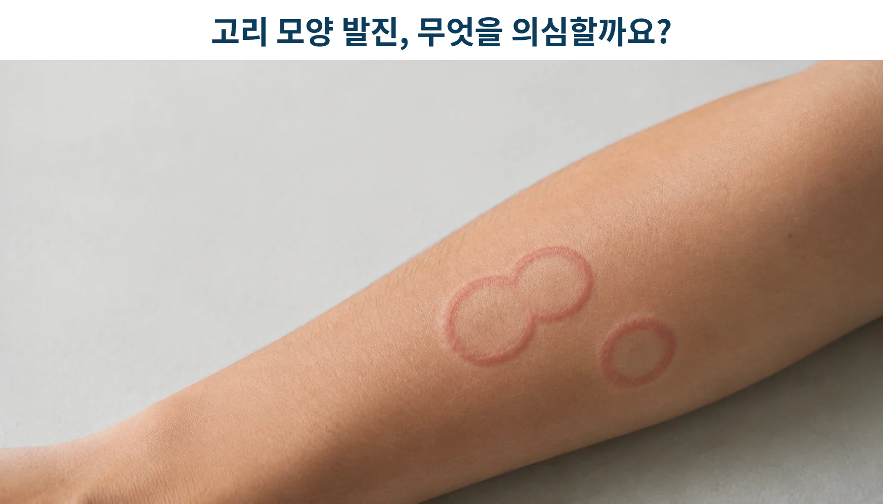 환상홍반(윤상홍반)이 나타나는 자가면역질환과 임상 특징 비교