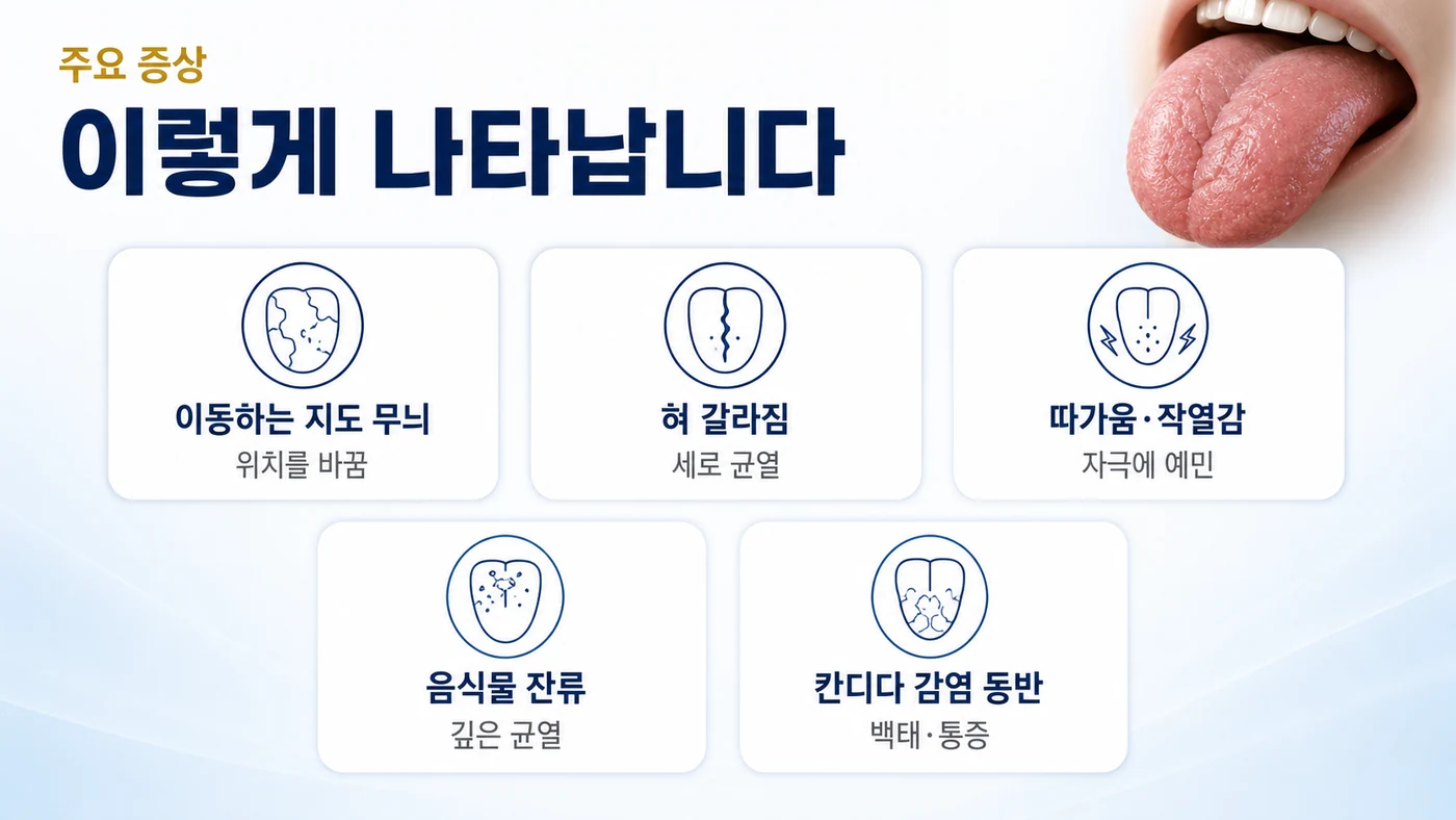 지도설·균열설의 주요 증상 — 위치를 바꾸는 지도 무늬, 혀의 세로 갈라짐, 자극에 따가운 작열감, 깊은 균열의 음식물 잔류, 칸디다 감염 동반