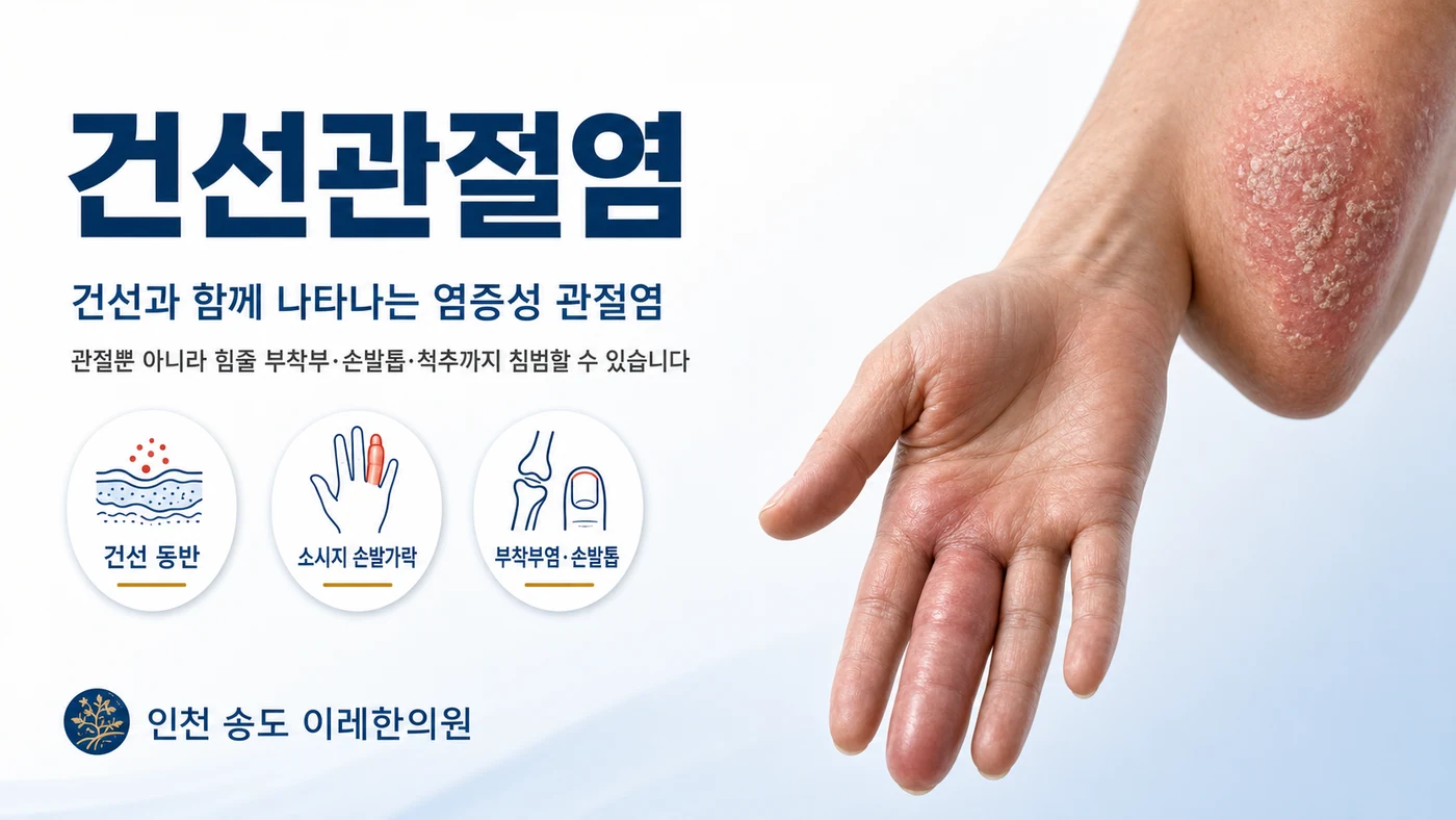 건선관절염