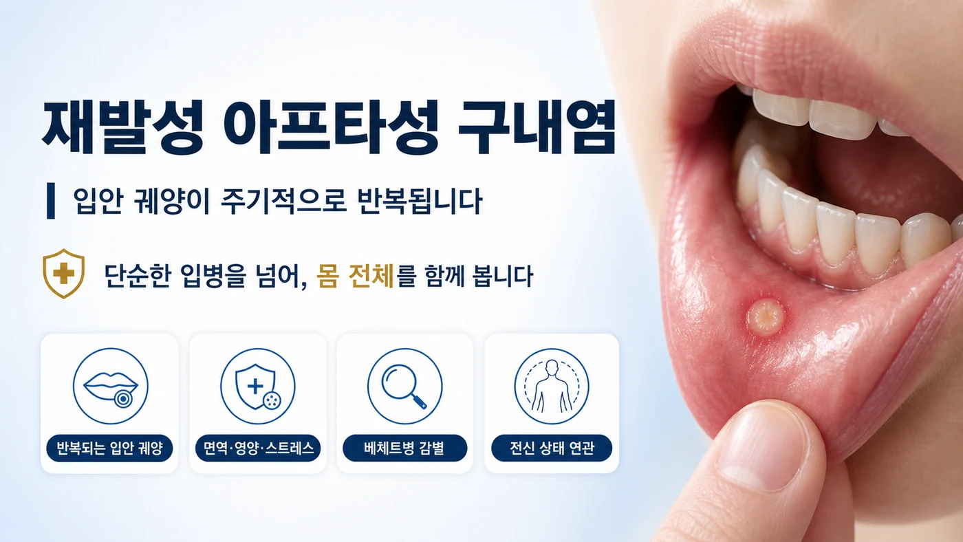 재발성 아프타성 구내염 안내 — 입안에 붉은 테두리와 흰 중심의 통증성 궤양이 주기적으로 반복되는 만성 염증성 질환